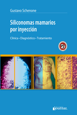 Siliconomas Mamarios por Inyección