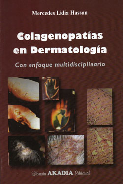 Colagenopatías en Dermatología