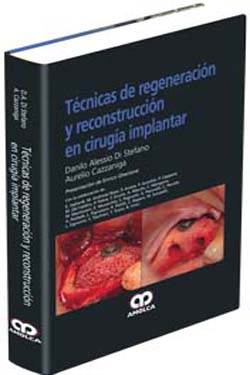 Técnicas de Regeneración y Reconstrucción en Cirugía Implantar
