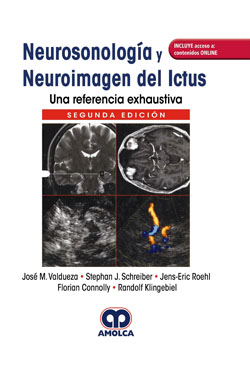 Neurosonología y Neuroimagen del Ictus
