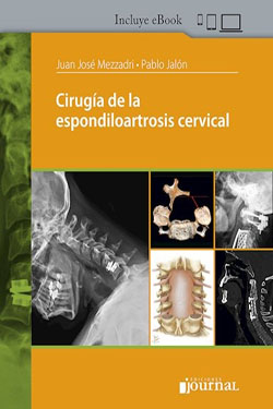 Cirugía de la Espondiloartrosis Cervical