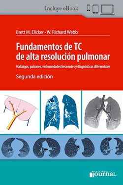 Fundamentos de TC de Alta Resolución Pulmonar